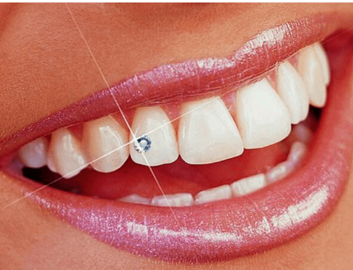 Diamond Dental - Tooth Jewellery